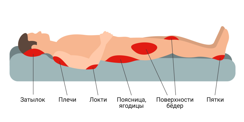 Типичные-места-с-высоким-риском-развития-пролежней-1.jpg