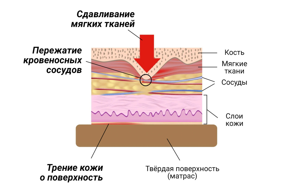 Образование-пролежней-Сдавливание.jpg